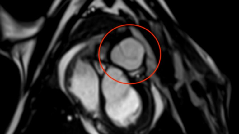 Human collagen-based pulmonary valve offers new hope for treating childhood heart disease