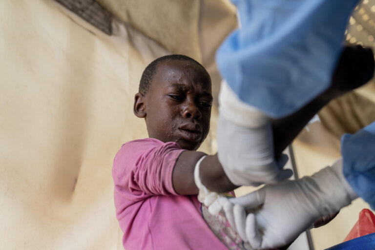 MPOX outbreak | New subtype under surveillance