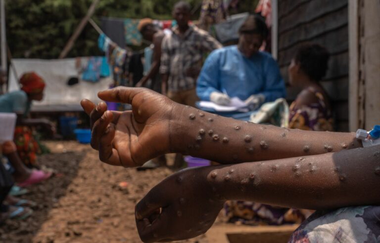 MPOX outbreaks in Africa could be over within 6 months, World Health Organization says