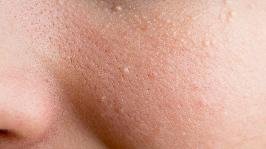 Effective Ways to Eliminate Milia Spots from Your Skin