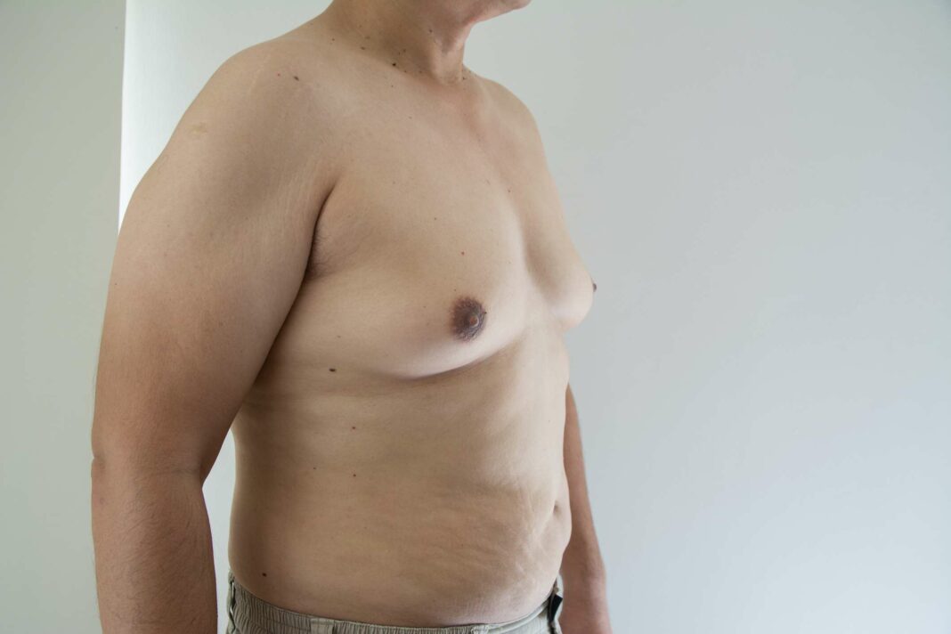 Exploring Men's Breast Health: Expert Insights on Hidden Risks