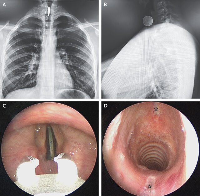   Radiographies du thorax (panneau A, vue postéro-antérieure) et du cou (panneau B, vue latérale).  Retrait avec une pince optique (Panneau C et Vidéo 1) et réinspection de l'ulcération (Panneau D, astérisques)