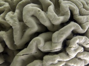 Une coupe d'un cerveau humain atteint de la maladie d'Alzheimer.