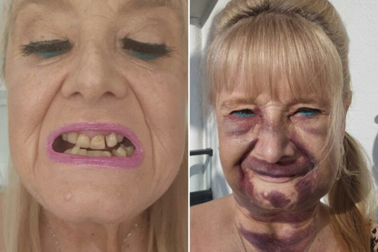 "Grandmother Loses 19 Teeth to Condition, Removes Remaining Yellow Ones" "Une grand-mère perd 19 dents à cause d'une condition, enlève les jaunes"